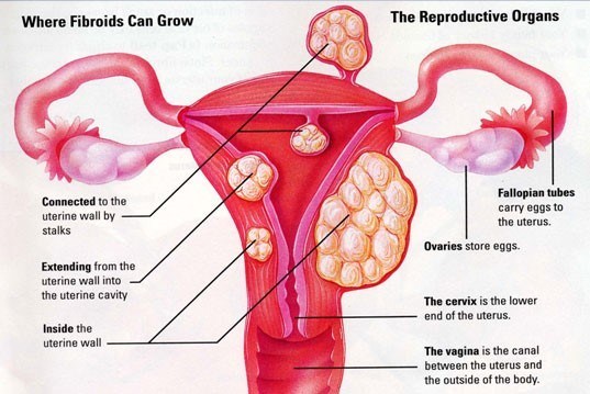 Uterine Fibroids Removal Treatment in Hyderabad