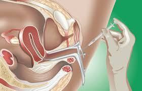 Hysteroscopy Surgery in Hyderabad